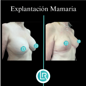 Explantacion Mamaria Dr Leonardo Rueda