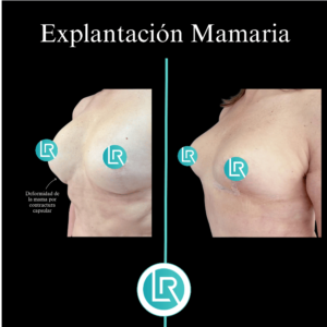 Explantacion Mamaria Dr Leonardo Rueda