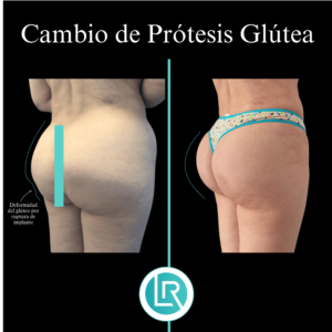 Gluteoplastia Dr Leonardo Rueda