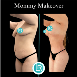 Mommy Makeover Dr Leonardo Rued