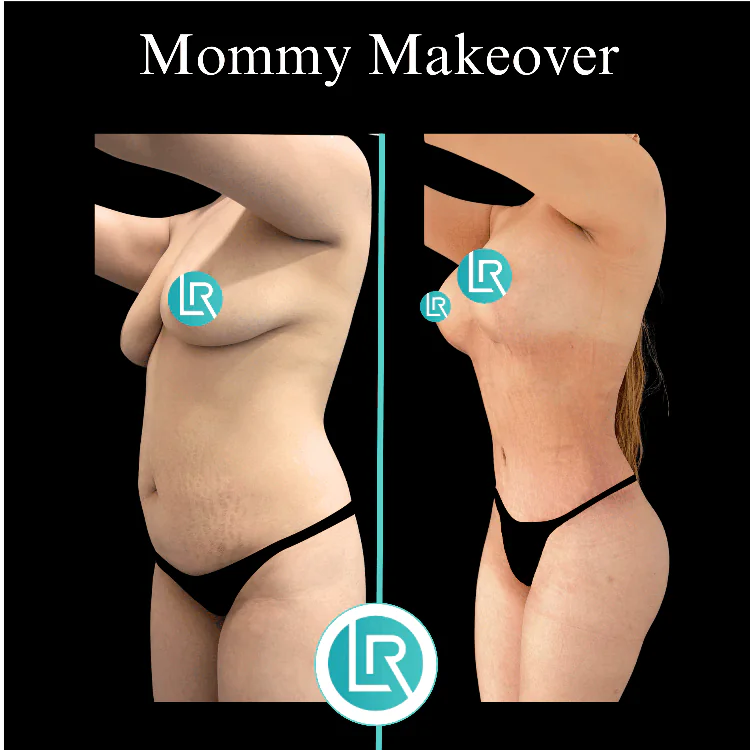 Mommy Makeover Dr Leonardo Rued