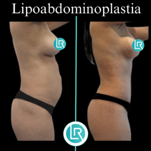 Lipoabdominoplastia Dr Leonardo Rueda