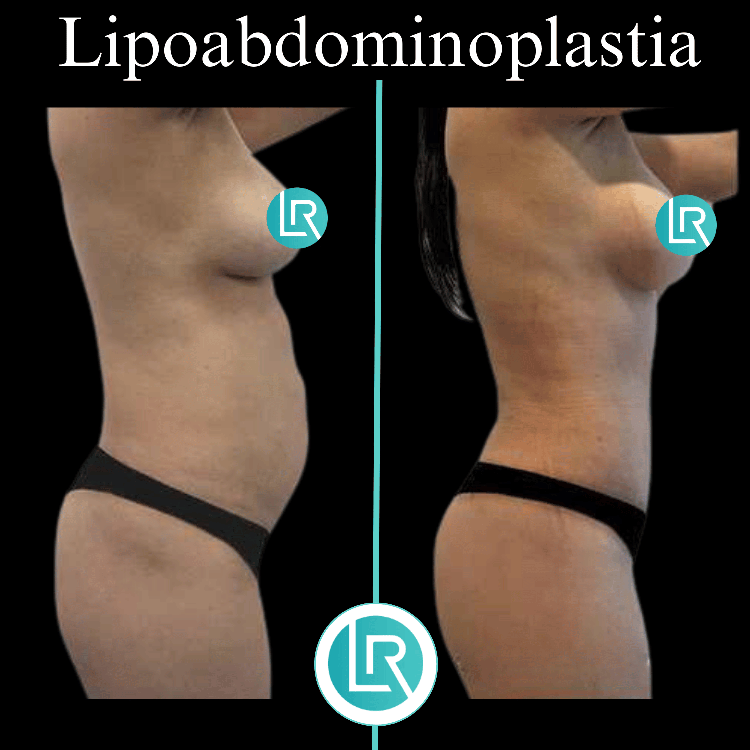 Lipoabdominoplastia Dr Leonardo Rueda