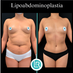 Lipoabdominoplastia Dr Leonardo Rueda