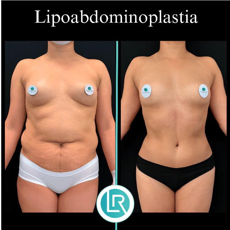 Lipoabdominoplastia Dr Leonardo Rueda