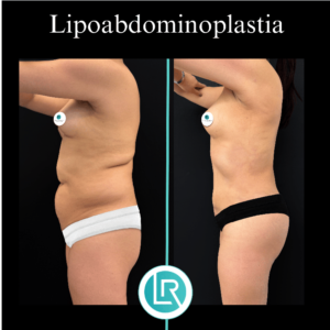 Lipoabdominoplastia Dr Leonardo Rueda