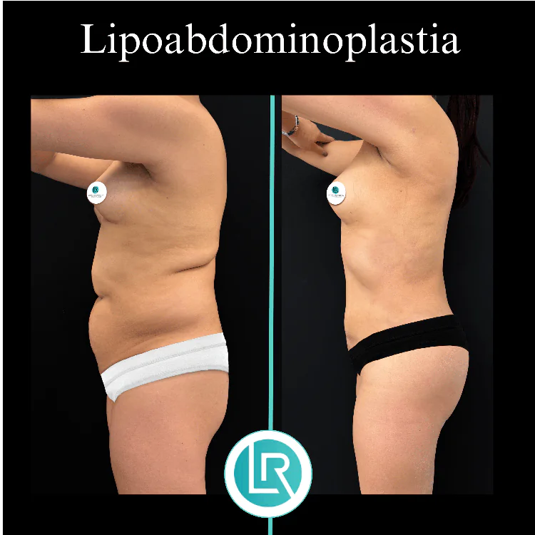 Lipoabdominoplastia Dr Leonardo Rueda