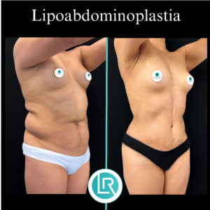 Lipoabdominoplastia Dr Leonardo Rueda