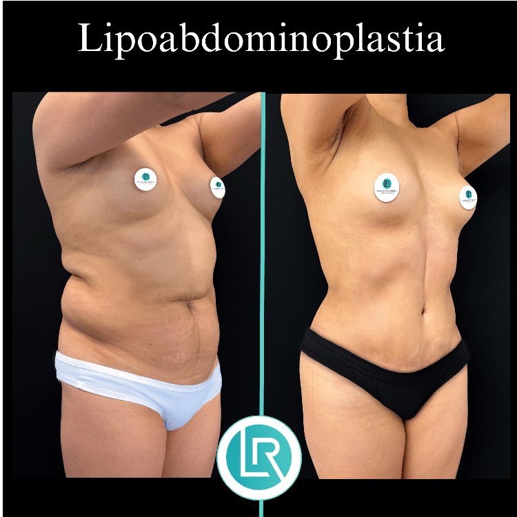 Lipoabdominoplastia Dr Leonardo Rueda