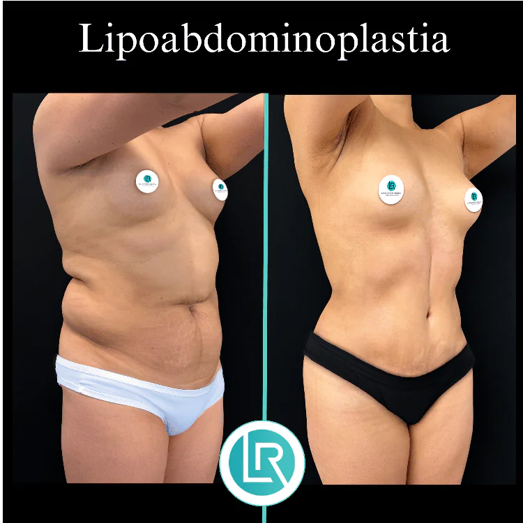 Lipoabdominoplastia Dr Leonardo Rueda