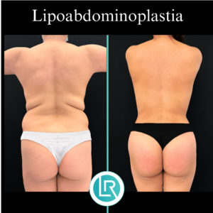 Lipoabdominoplastia Dr Leonardo Rueda