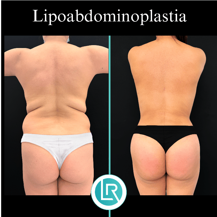 Lipoabdominoplastia Dr Leonardo Rueda