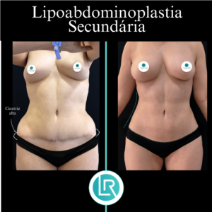 Lipoabdominoplastia Dr Leonardo Rueda