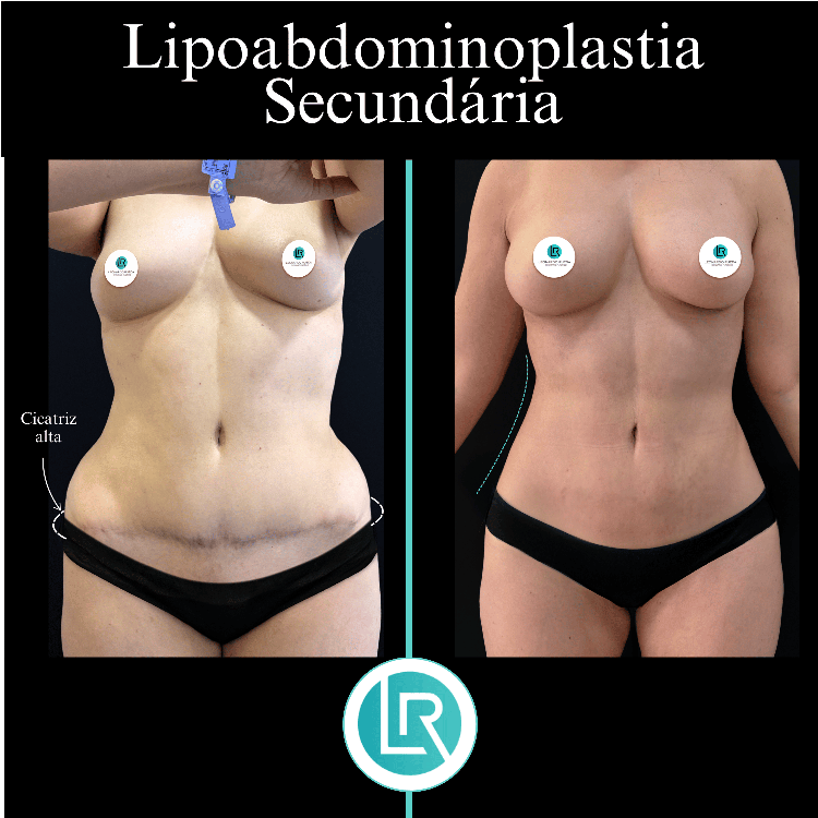 Lipoabdominoplastia Dr Leonardo Rueda
