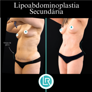Lipoabdominoplastia Dr Leonardo Rueda
