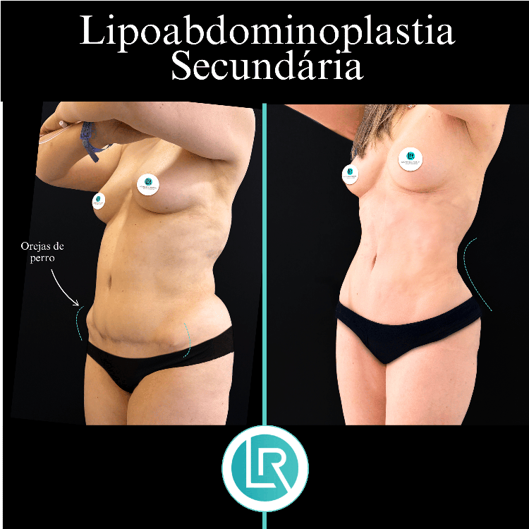 Lipoabdominoplastia Dr Leonardo Rueda