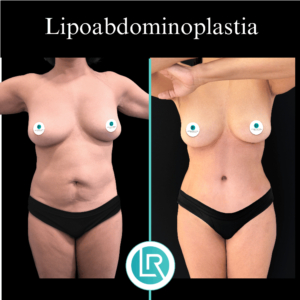Lipoabdominoplastia Dr Leonardo Rueda