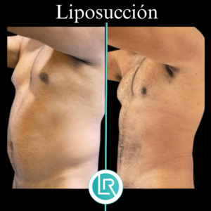Liposuccion Dr Leonardo Rueda