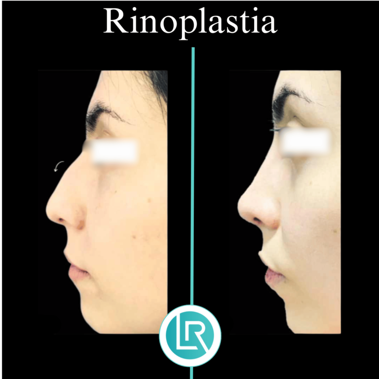 Rinoplastia Dr Leonardo Rueda