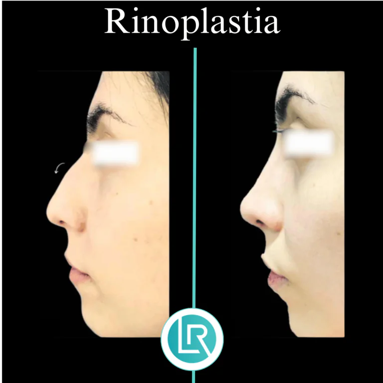 Rinoplastia Dr Leonardo Rueda