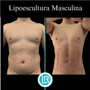 Lipoescultura Masculina Dr Leonardo Rueda