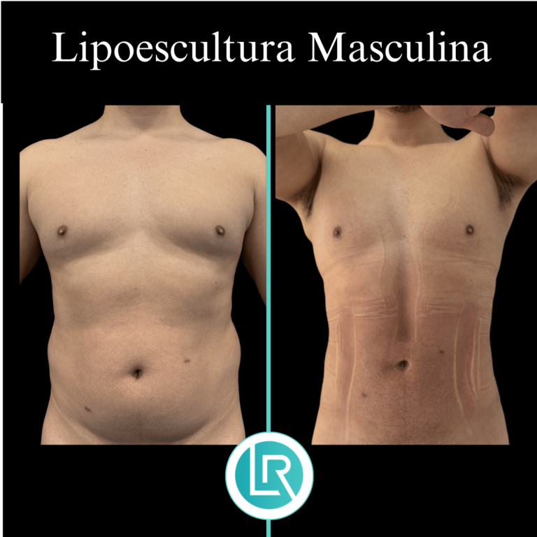 Lipoescultura Masculina Dr Leonardo Rueda