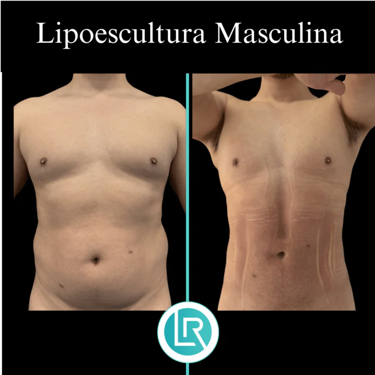 Lipoescultura Masculina Dr Leonardo Rueda