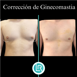 Correccion de Ginecomastia Dr Leonardo Rueda
