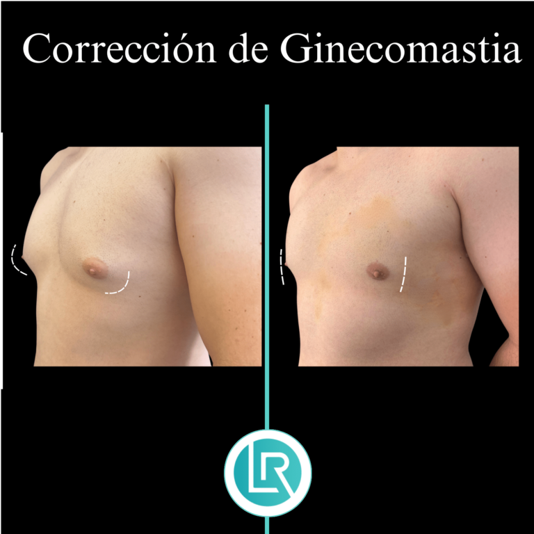 Correccion de Ginecomastia Dr Leonardo Rueda