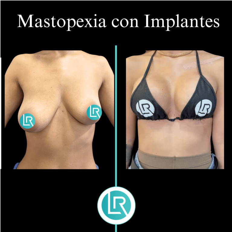 Mastopexia con Implantes Dr Leonardo rueda