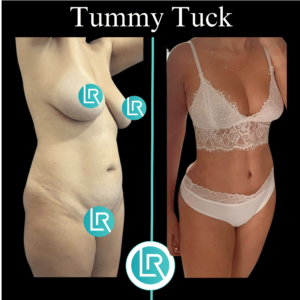 Tummy Tuck Dr Leonardo Rueda