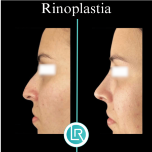 Rinoplastia Dr Leonardo Rueda