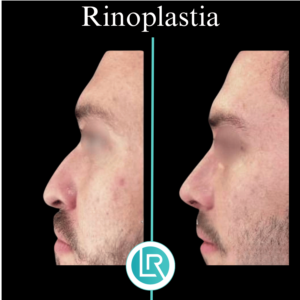 Rinoplastia Dr Leonardo Rueda