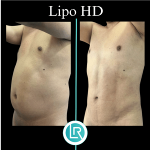 Lipo HD Dr Leonardo Rueda