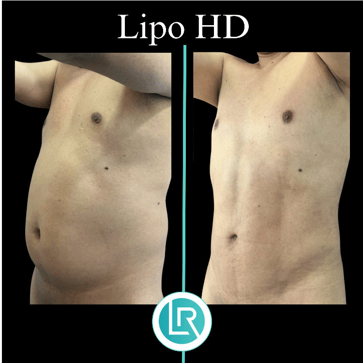 Lipo HD Dr Leonardo Rueda
