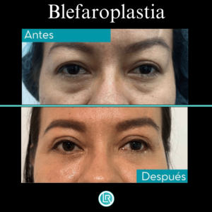 Blefaroplastia Dr Leonardo Rueda