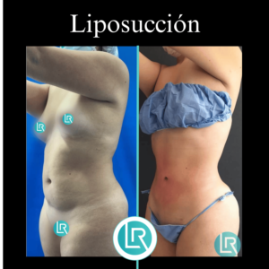 Dr Leonardo _ antes y despues - CORPORALES (3)