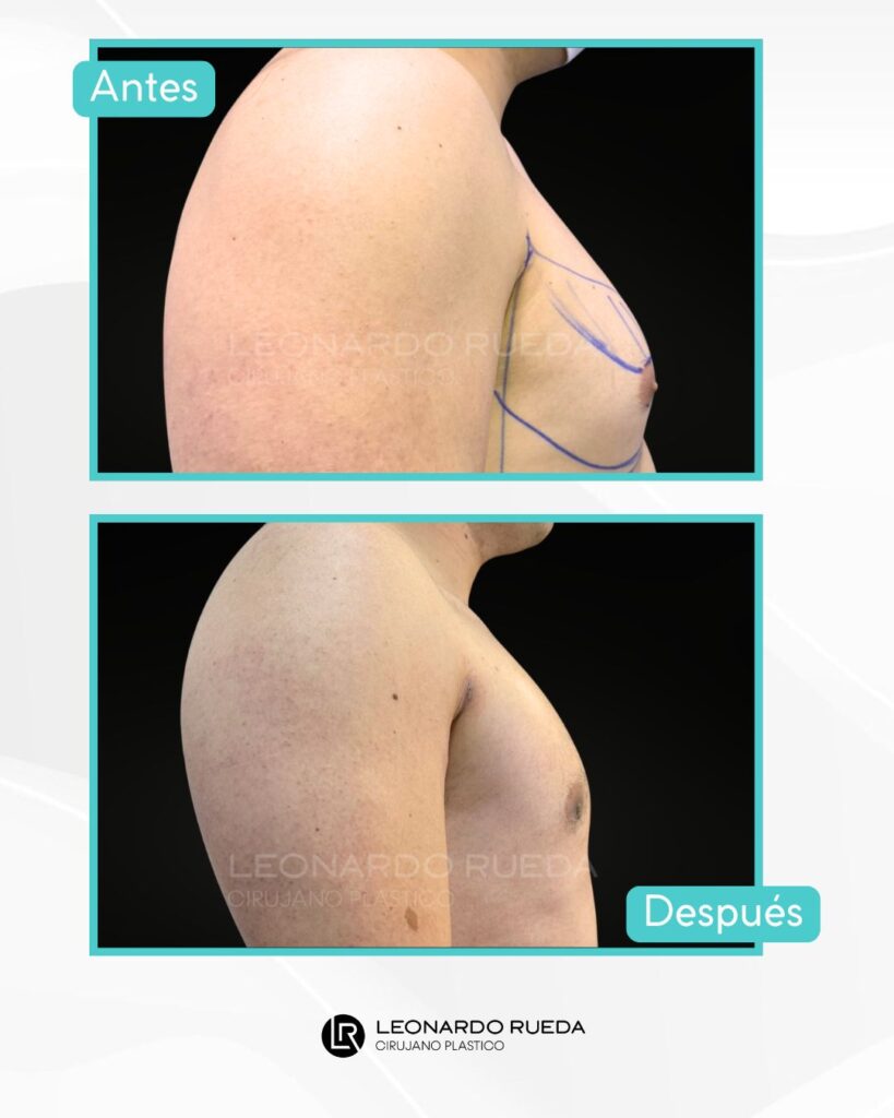 Ginecomastia Guía Médica Clara y Comprensible-DRLEONARDORUEDA8