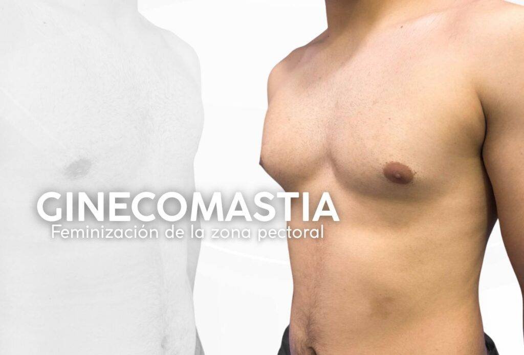 Cómo quitar la ginecomastia