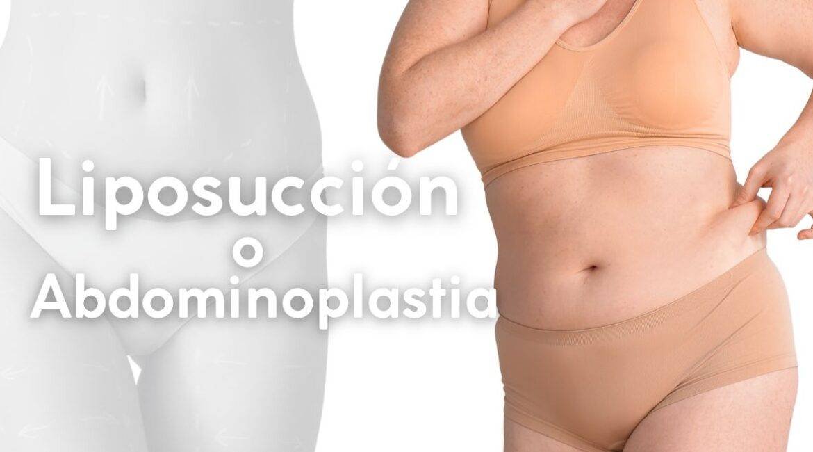 LIPOSUCCION O ABDOMINOPLASTIA