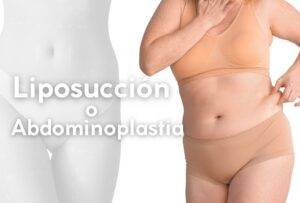 LIPOSUCCION O ABDOMINOPLASTIA
